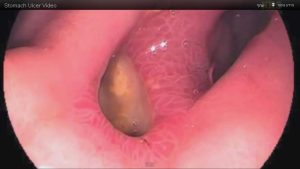 כיב קיבה או כיב בהשקה