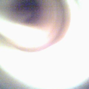 תסמונת וולף-הירשהורן (Wolf-Hirschhorn Syndrome)