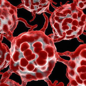 מחלת טיי זקס (Tay-Sachs Disease)