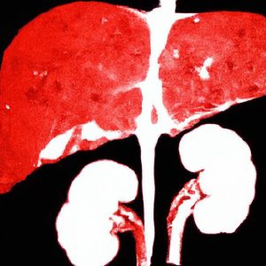 סרטן הכבד (Liver Cancer)