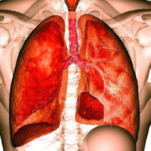תסחיף ריאתי מסיבי (Massive Pulmonary Embolism)
