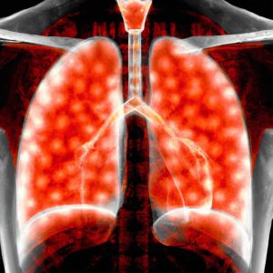 דלקת ריאות חיידקית מסכנת חיים (Life-threatening Bacterial Pneumonia)