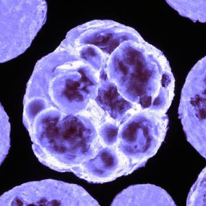 סרטן הדם (לוקמיה חריפה) (Acute Leukemia)